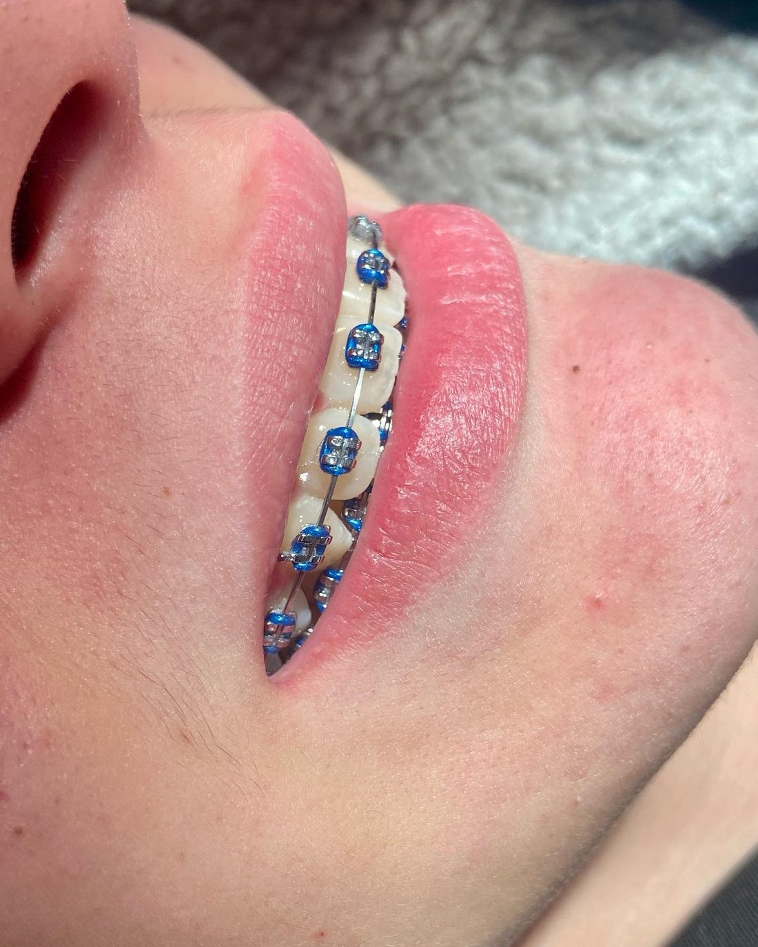 Procedimiento ortodoncia